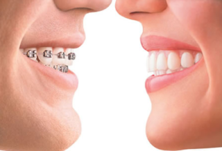 invisible braces cost in gurgaon