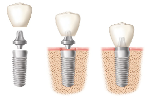 dental implant cost in gurgaon