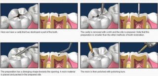 Teeth Gap Filling Treatment gurgaon