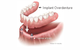 all on 4 dental implants in gurgaon