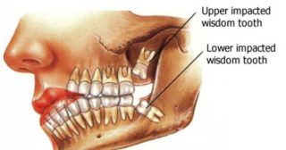 painless tooth extractions in gurgaon