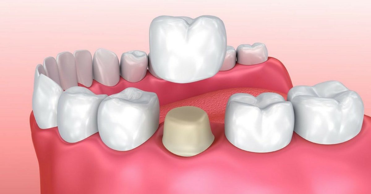 dental_crown_indications_sm-1200x628.jpg